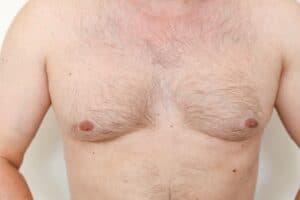 Gynecomastia Candidates Houston