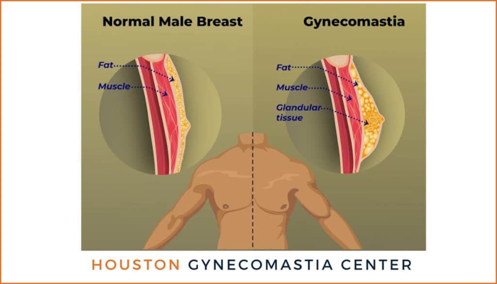 Gynecomastia Houston