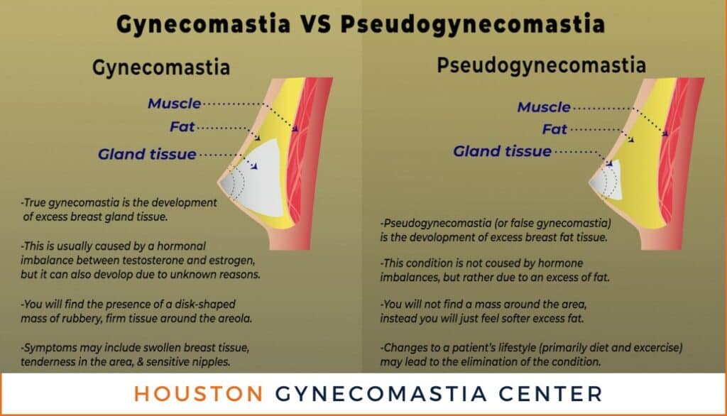 Pseudogynecomastia Surgery Houston
