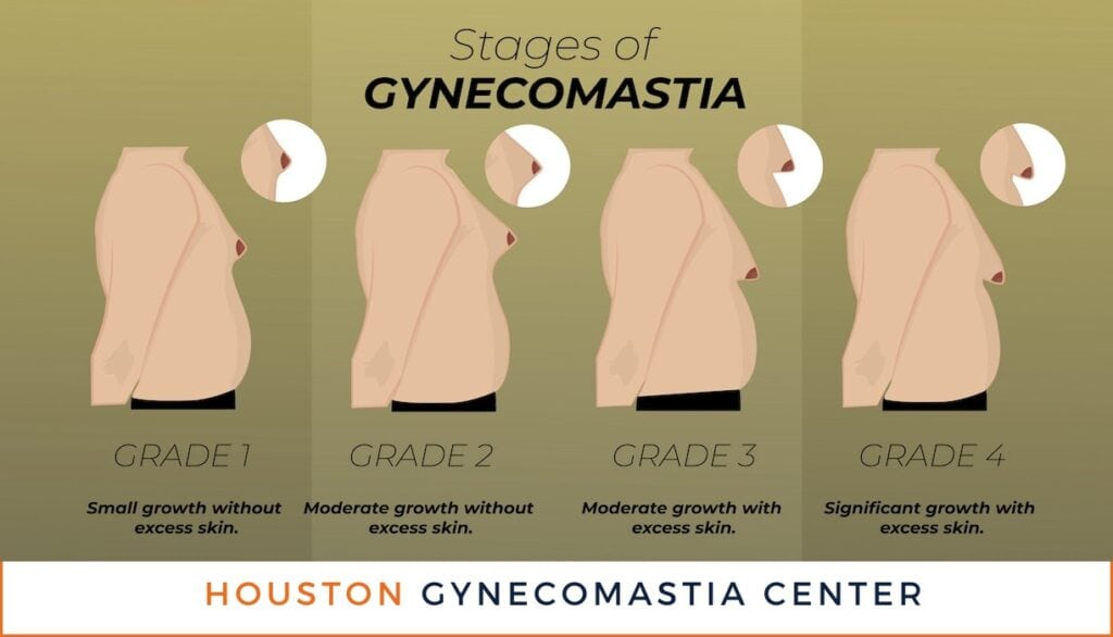 Stages Grades of Gynecomastia